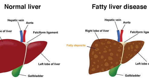 Belly Fat and Fatty Liver